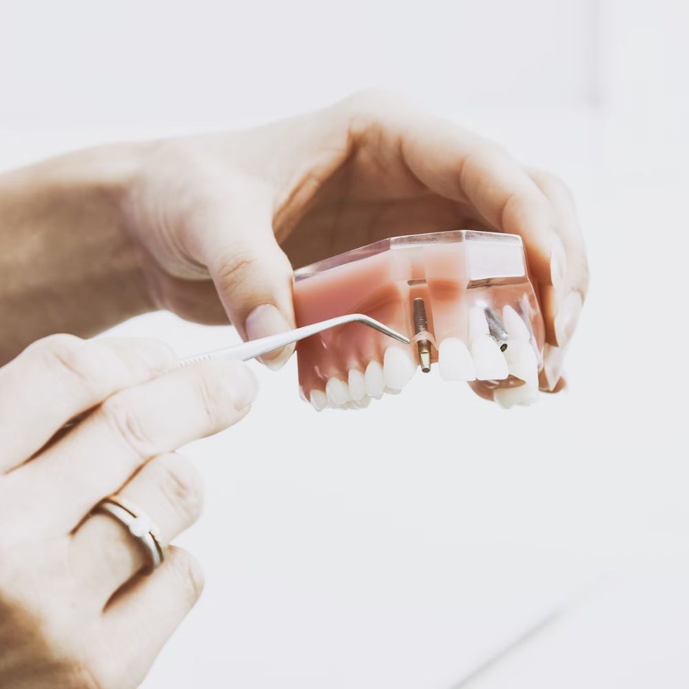 dental implants auckland